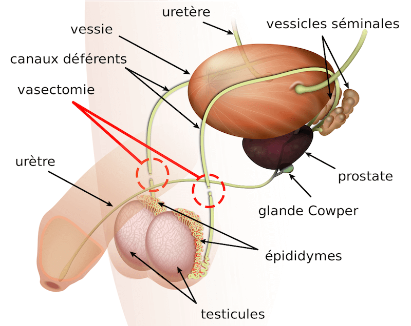 Vasectomie Un Choix De Contraception En Hausse D Couvrez Pourquoi